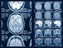 ressonância magnética do cérebro para diagnóstico. exame médico para a prevenção da doença. foto