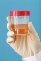 um recipiente para biomaterial com análise de urina na mão de um médico em uma luva de borracha branca sobre fundo azul. foto