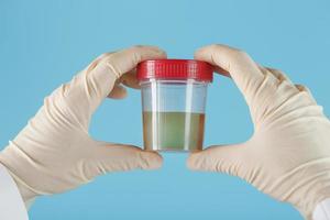 a mão enluvada do médico segura um recipiente transparente com um teste de urina. foto