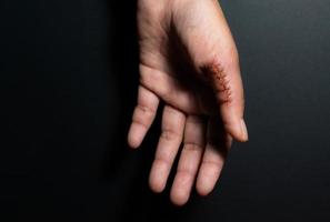 close-up de uma mão ferida com pontos, polegar ferida em fundo preto. cicatriz, sutura, acidente foto