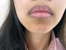 acne no rosto da mulher asiática. conceito de problema de beleza e pele foto