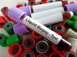 amostras de sangue para exame de sangue de biópsia líquida para detectar células cancerígenas ou fragmentos de dna que circulam na corrente sanguínea, câncer de pulmão, antecedentes laboratoriais. foto