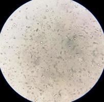 análise do sêmen sob microscopia mostrando piospermia ou leucocitospermia. análise de esperma. foto