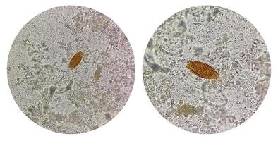 colagem de fotos de trichuris trichiura ova whipworm nas fezes, analisar por microscópio. ovo do parasita.