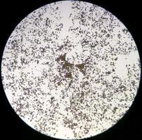 imagem microscópica de urinálise. exame de urina anormal. cristais de ácido úrico. foto