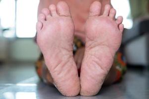 pés rachados, pele seca, close-up mulher sênior da ásia pés rachados, os calcanhares de uma mulher senoir asiática que muda de caminhar para o peso dos pés podem ser tratados com exercícios de perda de peso foto