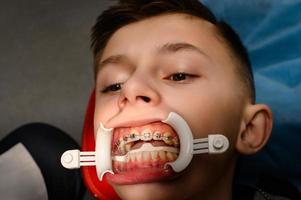visita ao ortodontista, colocação de aparelho nos dentes superiores, afastador branco nos lábios da criança.
