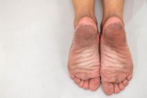 pés com pele seca para mostrar sobre o pé doente. deve ser muitas vezes tratamento em todos os dias. foto