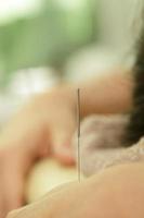 mão feminina com agulhas de aço durante o procedimento de terapia de acupuntura foto