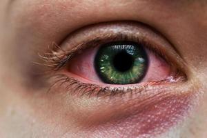 olho feminino infectado com íris verde e hemorragia subconjuntival foto