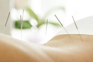 costas femininas com agulhas de aço durante o procedimento de terapia de acupuntura foto