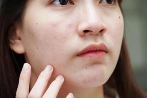 espinha de acne e cicatriz no rosto da pele, distúrbios das glândulas sebáceas, problema de beleza de cuidados com a pele de adolescente. foto