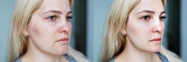 jovem mulher antes e depois do tratamento e maquiagem. foto