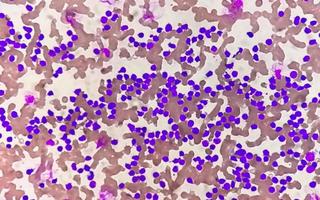 esfregaço de sangue sob microscopia mostrando leucemia linfoblástica crônica ou cll foto