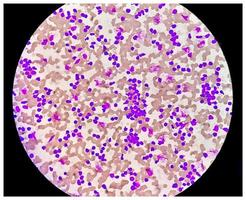 esfregaço de sangue sob microscopia mostrando leucemia linfoblástica crônica ou cll foto