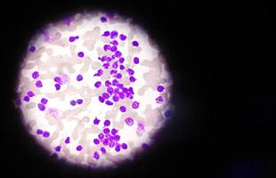 esfregaço de sangue sob microscopia mostrando leucemia linfoblástica crônica ou cll foto