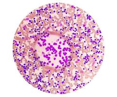 esfregaço de sangue sob microscopia mostrando leucemia linfoblástica crônica ou cll foto