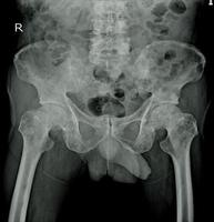 radiografia de ambos os quadris, impressão de múltiplas metástases ósseas. foto