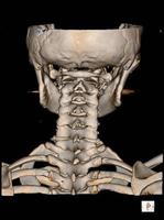 tomografia computadorizada da coluna cervical renderização 3 d. foto