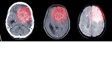 tomografia e ressonância magnética do cérebro. foto