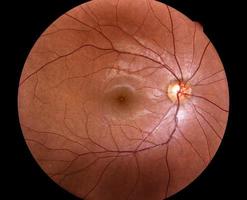 foto médica retina de diabético - exsudato