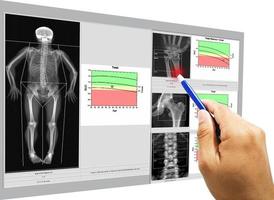 densidade óssea de imagem médica de exame especial corpo inteiro e pulso feminino de 65 anos, quadril, coluna, imagem muito embaçada quando visualiza solução completa, conceito médico e de tecnologia. foto