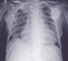radiografia de tórax evere cardiomegalia. congestão pulmonar moderada. foto