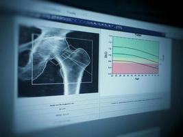 densitômetro ósseo relatório de quadril pape foto