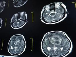 achado de ressonância magnética cerebral de meningioma foto