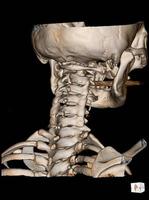 tomografia computadorizada da coluna cervical renderização 3 d. foto