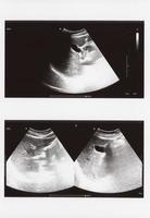 ultrassonografia de abdome completo foto