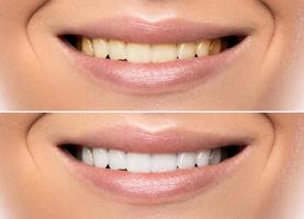boca feminina. comparação antes e depois do clareamento dental foto