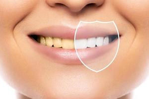 clareamento e higiene dos dentes. resultado após tratamento em clínica odontológica profissional. foto