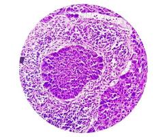 fotomicrografia mostrando carcinoma espinocelular de língua grau ii. scc invasivo oral. foto