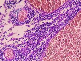 fotomicrografia de adenocarcinoma de estômago. adenocarcinoma gástrico. foto