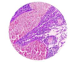 fotomicrografia de adenocarcinoma de estômago. adenocarcinoma gástrico. foto