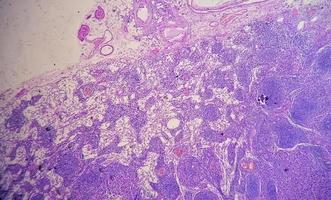 fotomicrografia de adenocarcinoma de estômago. adenocarcinoma gástrico. foto