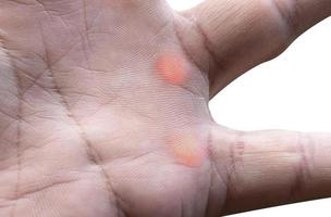 esclerodermia na palma da mão isolada no fundo branco com traçado de recorte foto