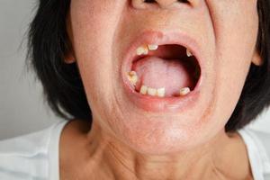 uma idosa asiática sorriu e viu os dentes restantes na boca. devido à perda parcial, resultando na necessidade de usar dentes artificiais. o conceito de boa saúde oral foto