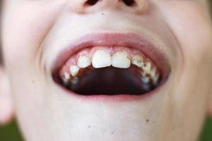 boca aberta de um menino com placa ou cálculo nos dentes próximos. conceito de higiene bucal foto