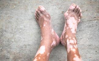 a perna do velho com problema de pele que causa perda de melanina posando dentro de casa. o modelo de pé em regata preta sofrendo de distúrbio de vitiligo.