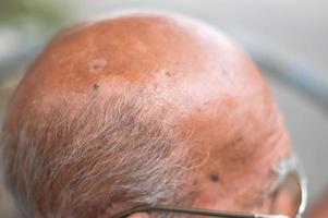 a cabeça do velho com condição de pele que causa perda de melanina posando dentro de casa. o modelo de cabeça em regata preta sofrendo de distúrbio de vitiligo.