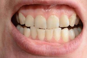 uma jovem mostra seus dentes tortos que precisam de ajuda médica em close-ups foto