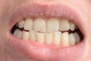 uma jovem mostra seus dentes tortos que precisam de ajuda médica em close-ups foto