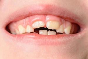 a criança abre a boca, mostrando os dentes tortos após a queda dos dentes de leite