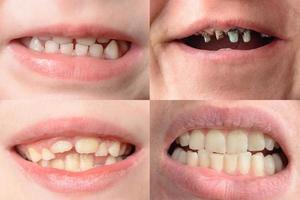 um conjunto de quatro fotografias de pessoas com curvas e dentes podres foto