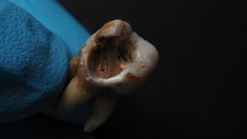 cárie dentária e mão de dentista com luva e fundo preto. foto