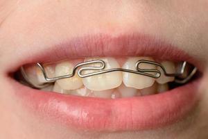 boca fechada de dentes tortos com aparelho escova de dentes na boca do adolescente