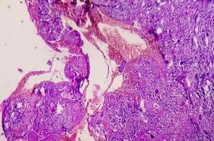 biópsia de tumor espinhal mostrando meningioma psamomatoso. corpos de psamoma. foto