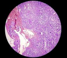 biópsia de tumor espinhal mostrando meningioma psamomatoso. corpos de psamoma. foto